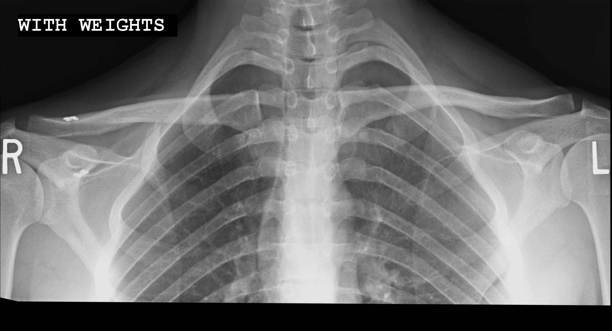 acromioclavicular-joint-separation-shown-using-medical-animation