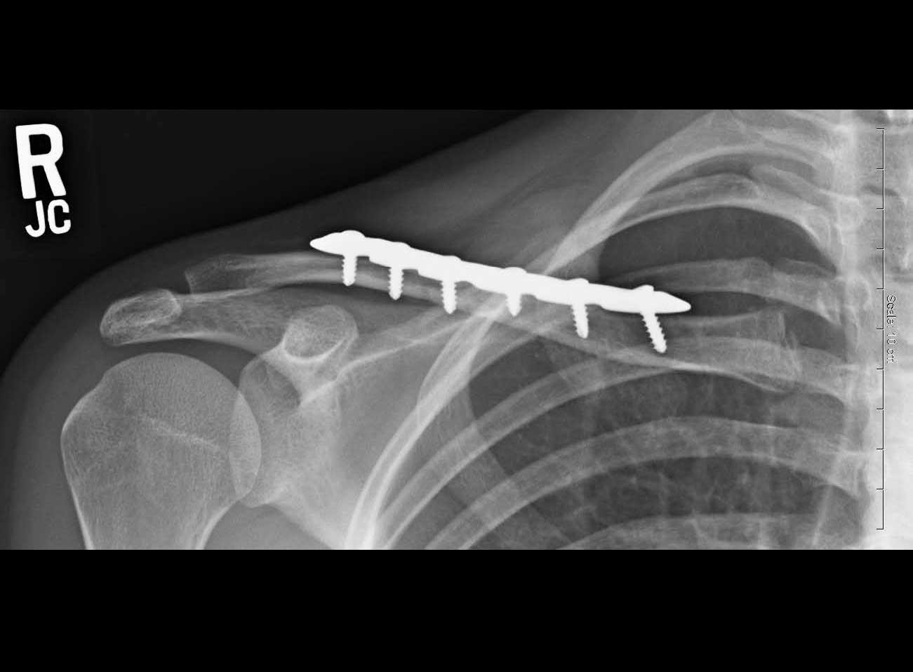 clavicle-fractures-fracture-healing