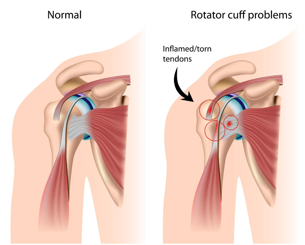 Image result for rotator cuff surgery