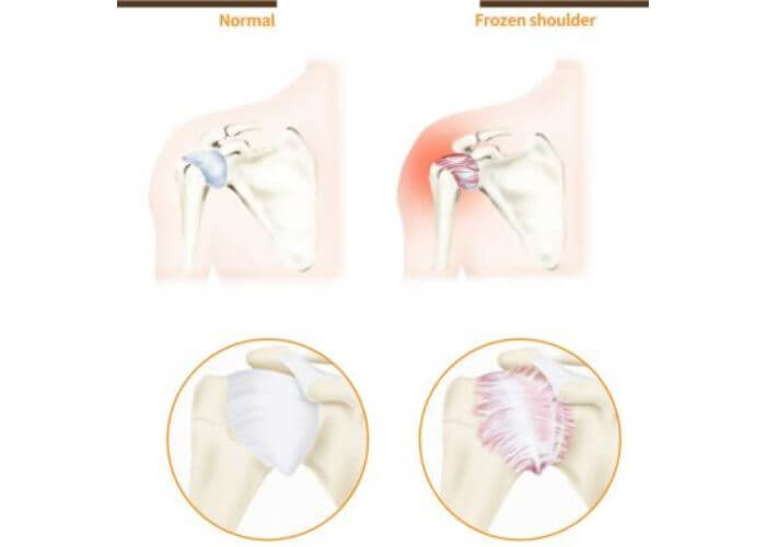 Shoulder Conditions Archives Jervis Yau MD Orthopedic Surgeon