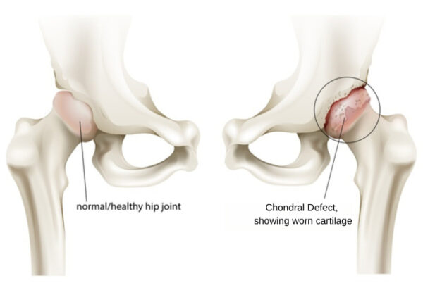 Chondral Defect of Hip | Santa Barbara CA
