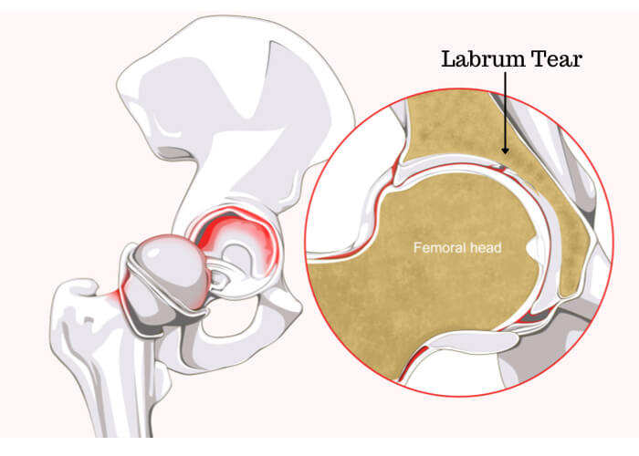 Hip Labral Surgery Hip Surgeon Santa Barbara Santa Maria Ventura Ca