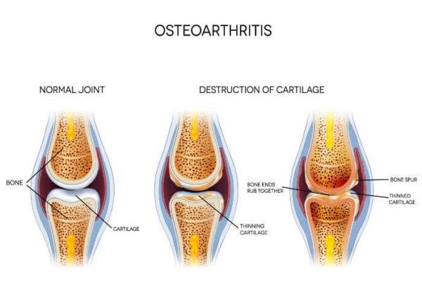 Arthritis Knee | Santa Barbara CA